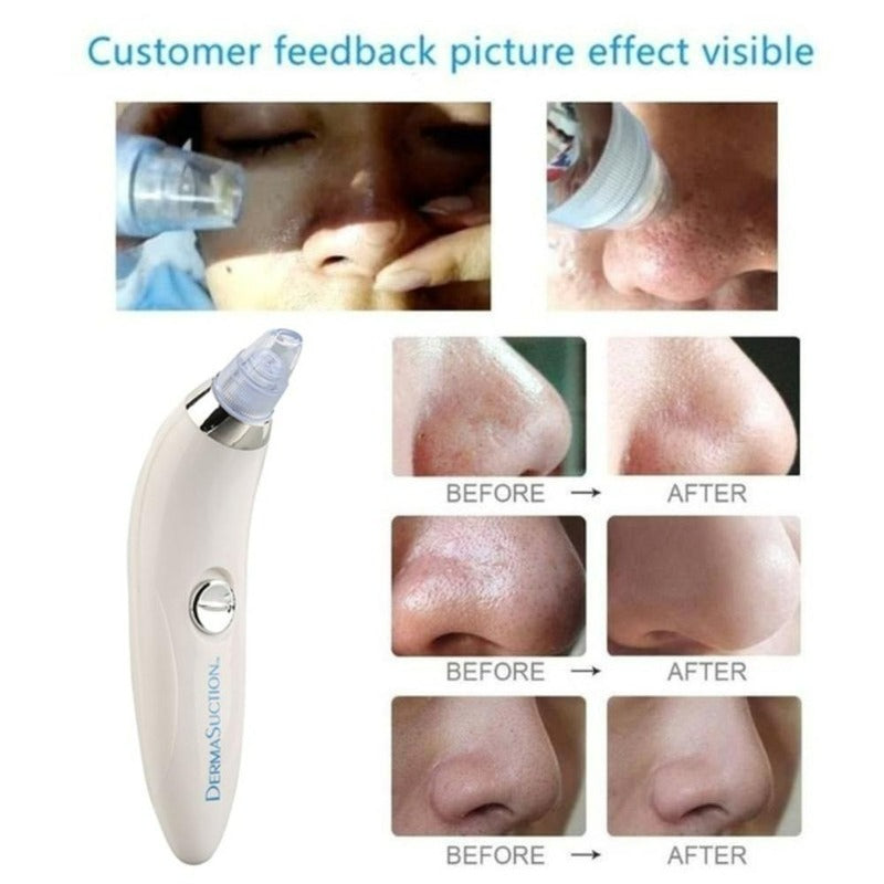 Blackhead Remover Vaccum Suction